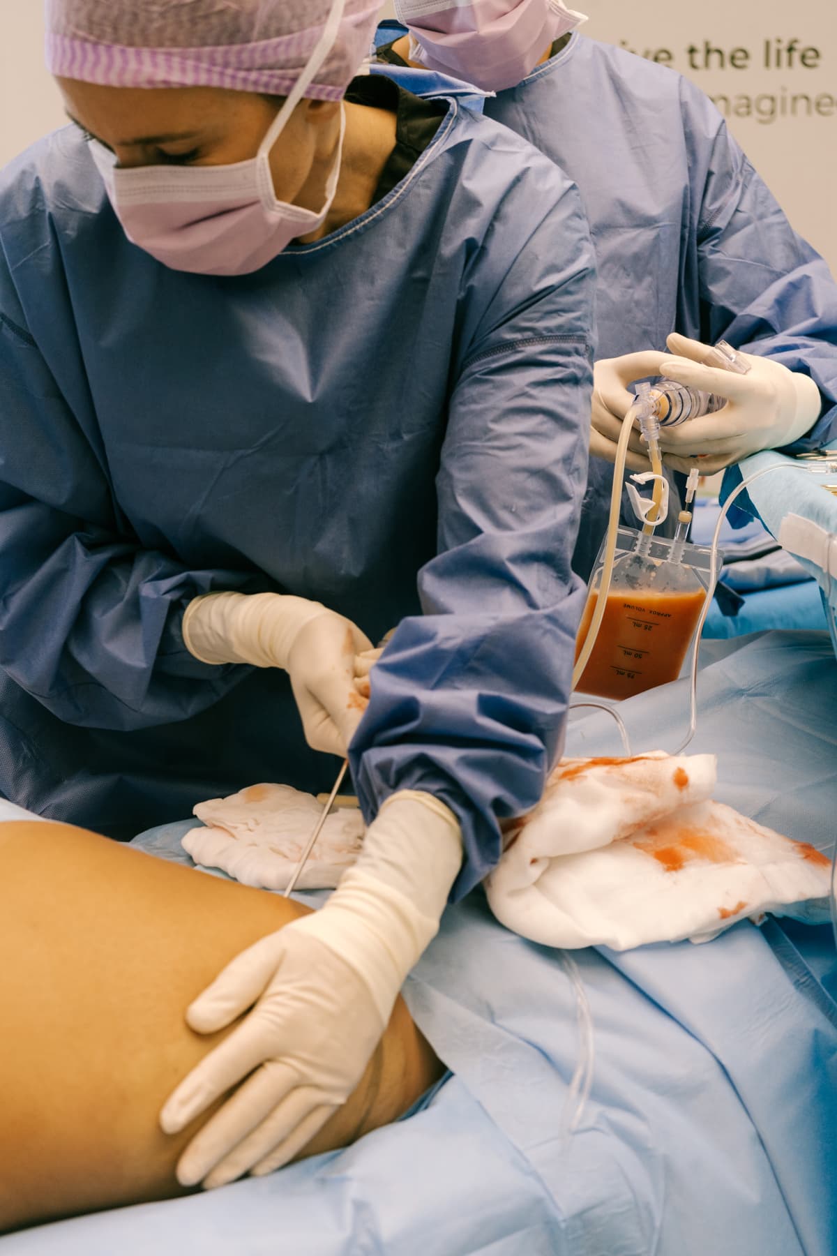 Lipografter System